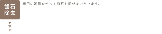 歯石除去