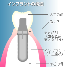 インプラントの構造